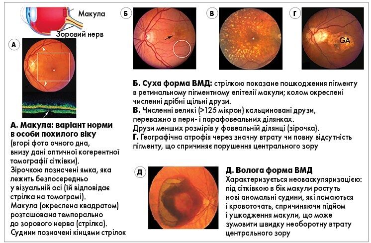 Оптимізація лікування сухої форми вікової макулярної дегенерації