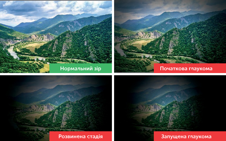Що таке глаукома?